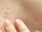 Vaiolo delle Scimmie, New York dichiara lo stato di emergenza