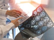 Sclerosi multipla, è in arrivo un nuovo farmaco